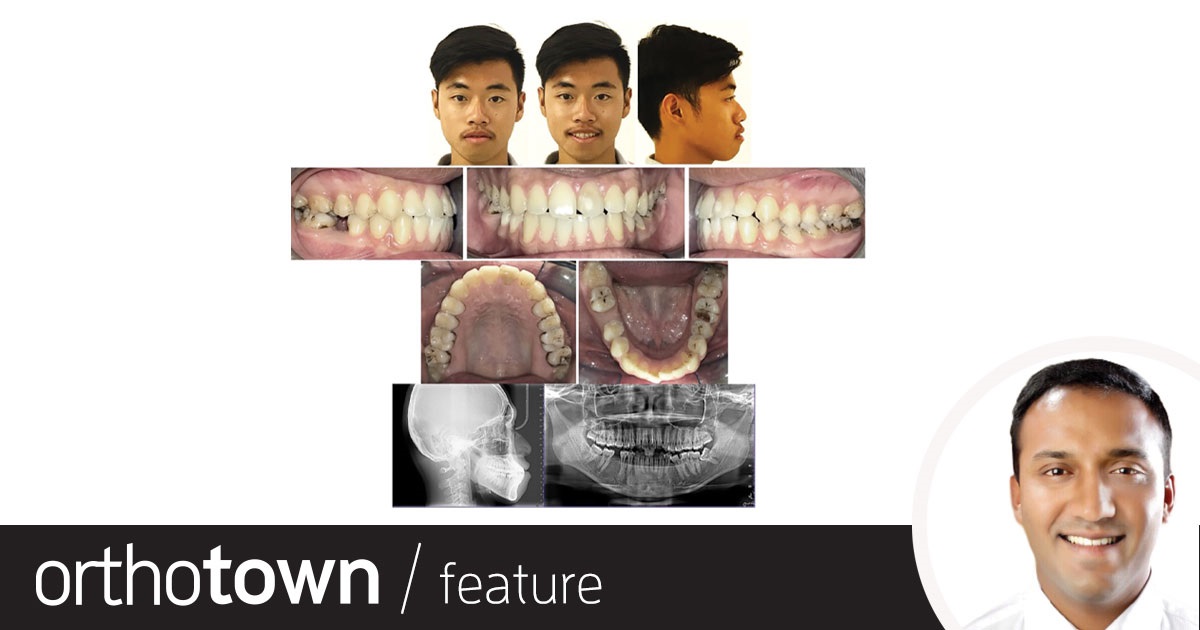 Townie Treatment Case: Small But Mighty Dr. Adith Venugopal shares a case study in which he used extraradicular miniscrews to encourage tooth movement during whole-arch distalization to help correct lip incompetence and bidental protrusion.