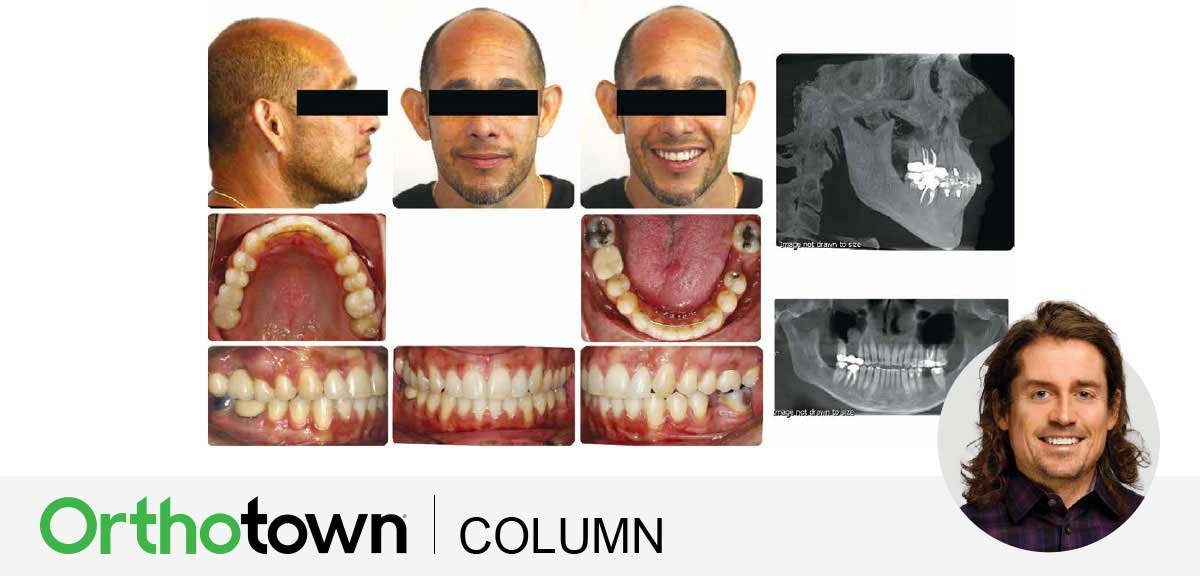 A Voice in the Arena: The Importance of Timing IPR Editorial director Dr. Chad Foster discusses the importance of properly timing interproximal reduction and shares a case study
illustrating the principles involved. 