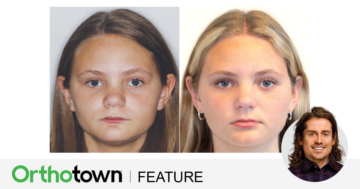 ‘Short-Face’ Patients—Part 3 Orthotown Editorial Director Dr. Chad Foster continues his four-part series on treatment considerations for patients whose faces have short lower thirds.