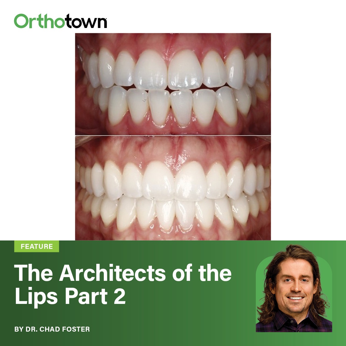 The Architects of the Lips: Part 2 Dr. Chad Foster examines full lips versus excess circumoral fullness, reframing extraction decisions around aesthetics, incisor position, and treatment goals.
