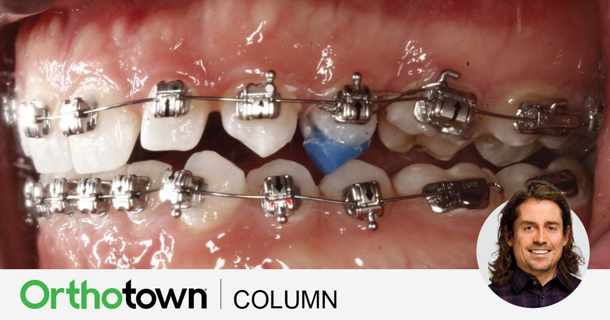 A Voice in the Arena: Bite Ramps Used for Anchorage Editorial director Dr. Chad Foster shares a few cases in which he’s using bite ramps as anchorage.