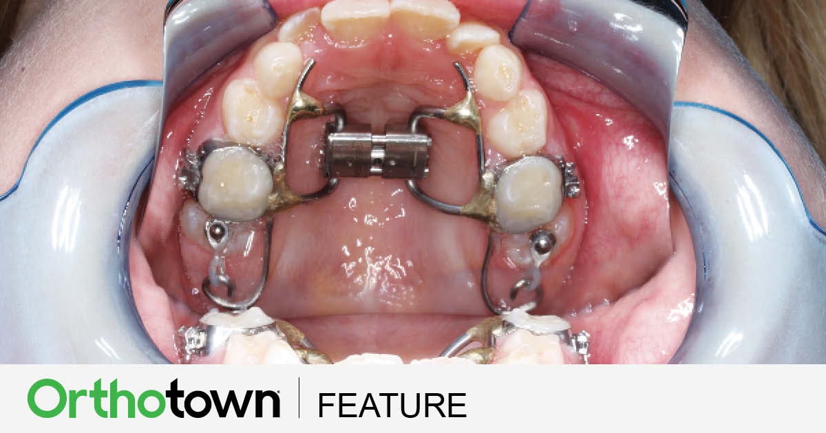 Case Study: Hyrax-Halterman Appliance A case study from Dr. Chris Teeters discusses his use and manipulation of the Hyrax-Halterman device.