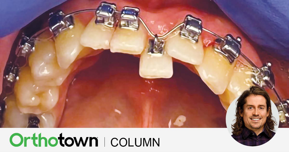 A Voice in the Arena: Eyelets–The Magic Bracket Editorial Director Dr. Chad Foster explains the biomechanics behind eyelets—how they harness
superelastic NiTi wires for optimal force delivery and efficient tooth movement.