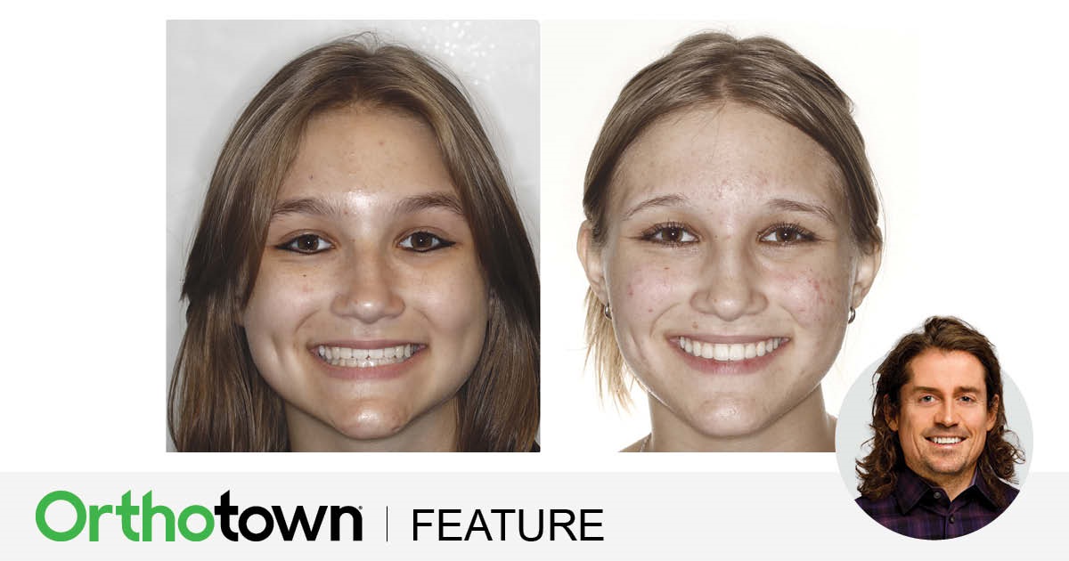 ‘Short-Face’ Patients—Part 4 Dr. Chad Foster concludes his four-part series, exploring treatment strategies for “short-face” patients and the transformative impact of vertical changes in orthodontics.