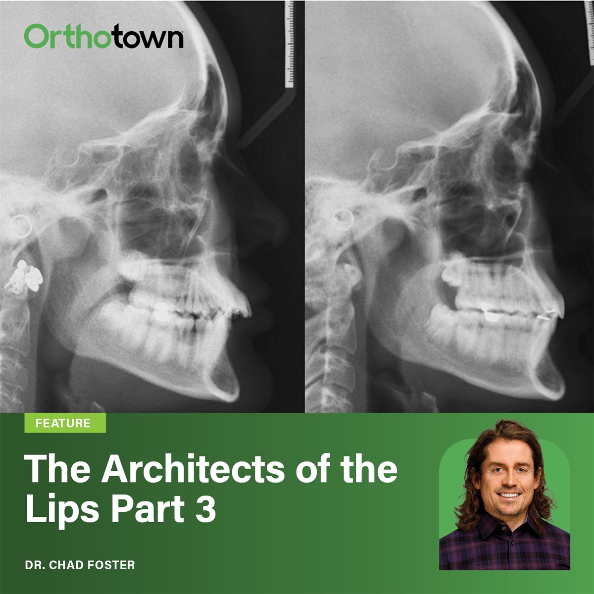 The Architects of the Lips: Part 3 Dr. Chad Foster uses two contrasting cases to show why extraction decisions involving incisor retraction must account for macro-facial aesthetics and lip position, not cephalometric values alone.