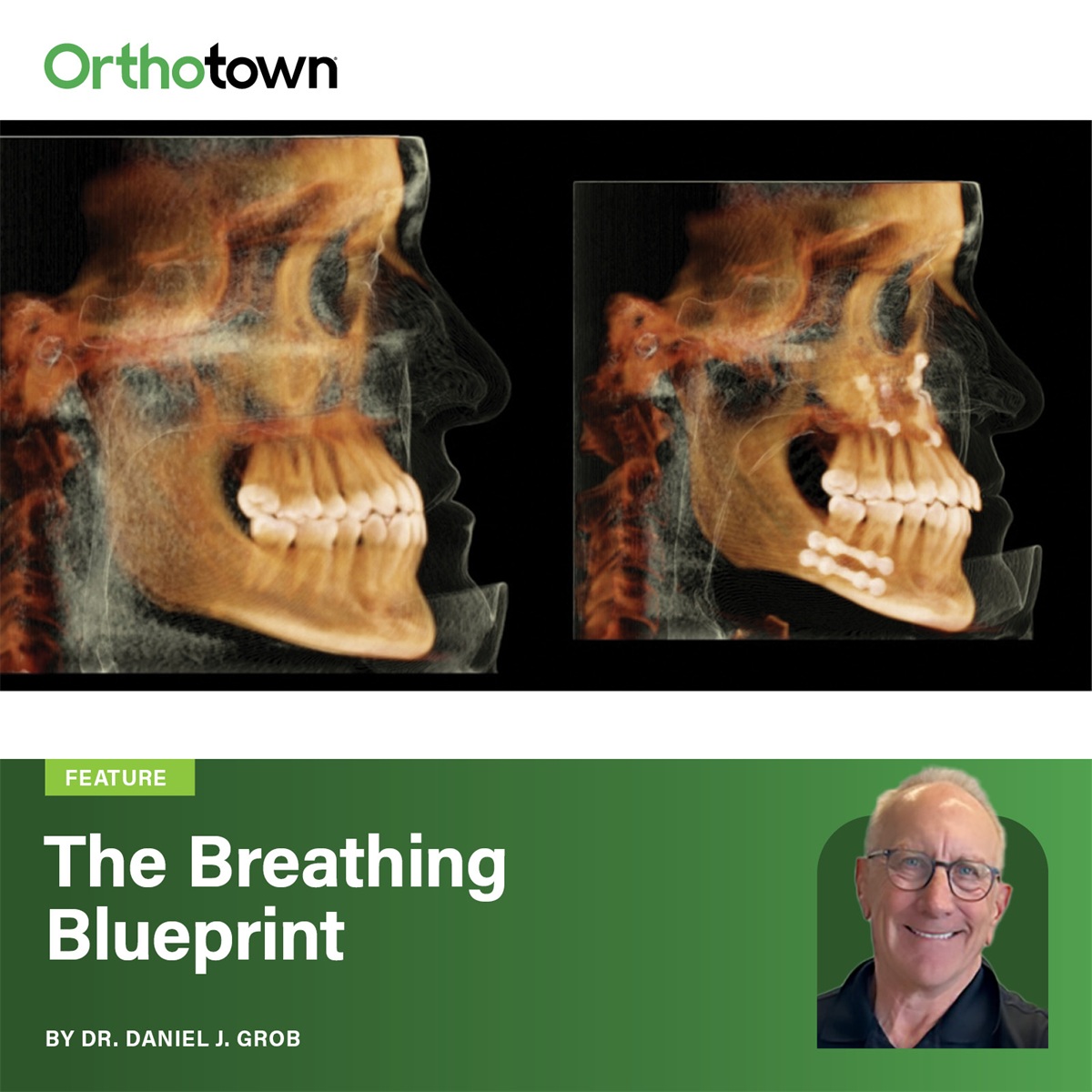 The Breathing Blueprint Dr. Daniel J. Grob walks through four patient cases where CBCT evaluation and interdisciplinary referrals produced meaningful improvements in breathing, sleep quality, and treatment outcomes.