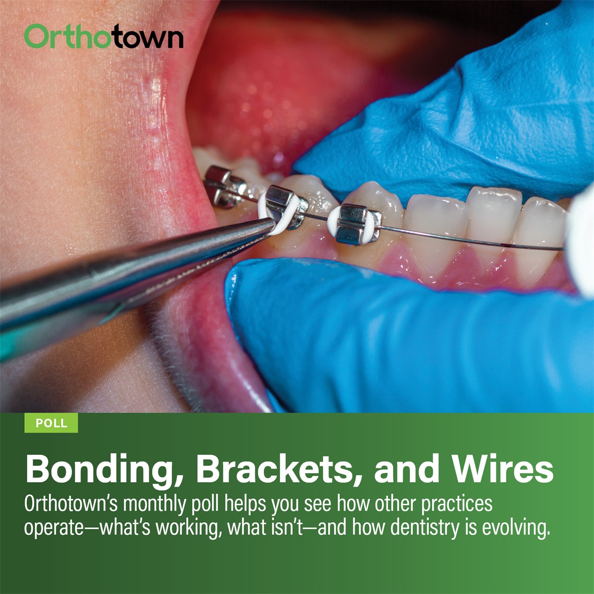 Poll: Bonding, Brackets, and Wires Orthotown’s monthly poll helps see how other practices operate. This month Townies weigh in on bonding, brackets, and wires