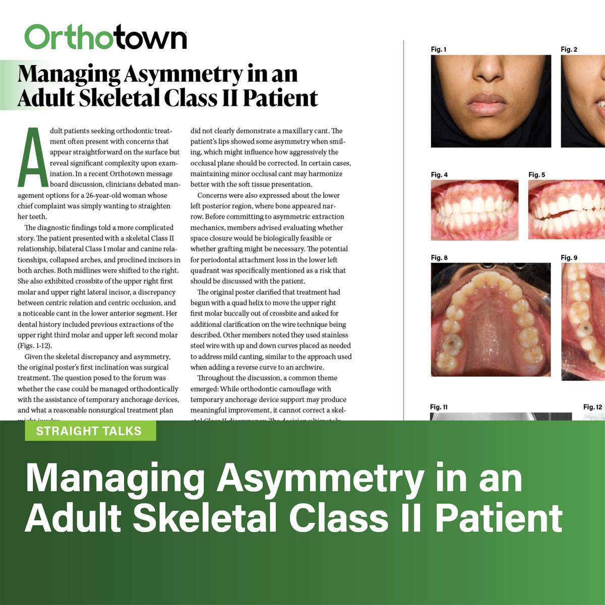 Managing Asymmetry in an Adult Skeletal Class II Patient 