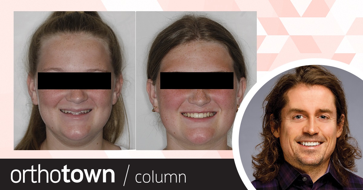 A Voice in the Arena: Aesthetic Importance of Upper Incisor Vertical Position Orthotown Editorial Director Dr. Chad Foster shares a patient case in which the position of upper incisors within the lip frame became of singular importance during treatment.
