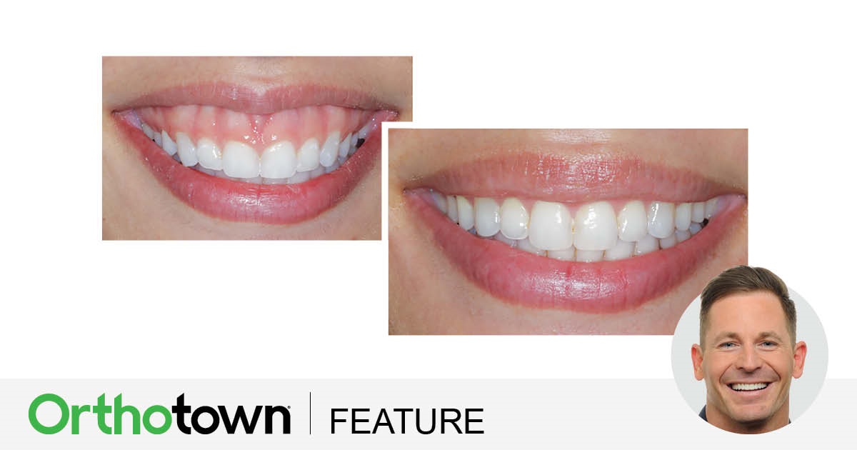 Townie Treatment Case: Gummy Smile Treatment With Aligners Although gummy smiles are usually treated using TADs and braces, Orthotown editorial board member Dr. Trevor Nichols shares a case in which he successfully treated a patient using TADs and clear aligners.