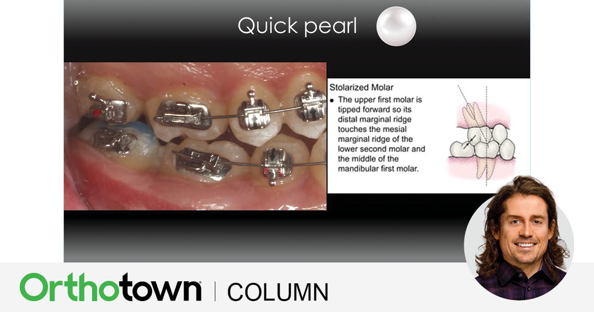 A Voice in the Arena: Simple but Powerful Editorial director Dr. Chad Foster shares a technique for proper
positioning of maxillary molar tubes.