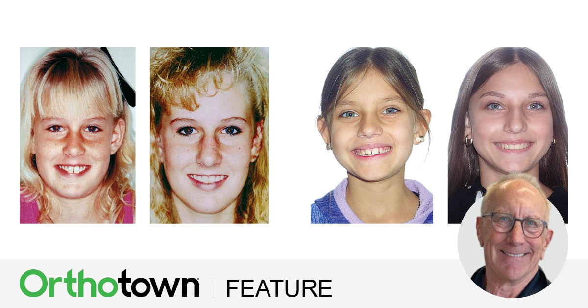 A Tale of Two Cases Dr. Daniel J. Grob reflects on 40 years of
orthodontic evolution, comparing past and
present treatment approaches for Class II
malocclusions through real case studies.