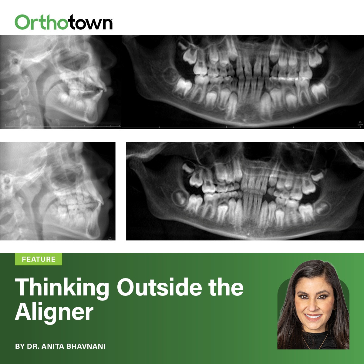 Thinking Outside the Aligner Dr. Anita Bhavnani walks through a Phase I case using Angel Aligner KiD to correct a Brodie bite in the mixed dentition with cross-elastic mechanics.