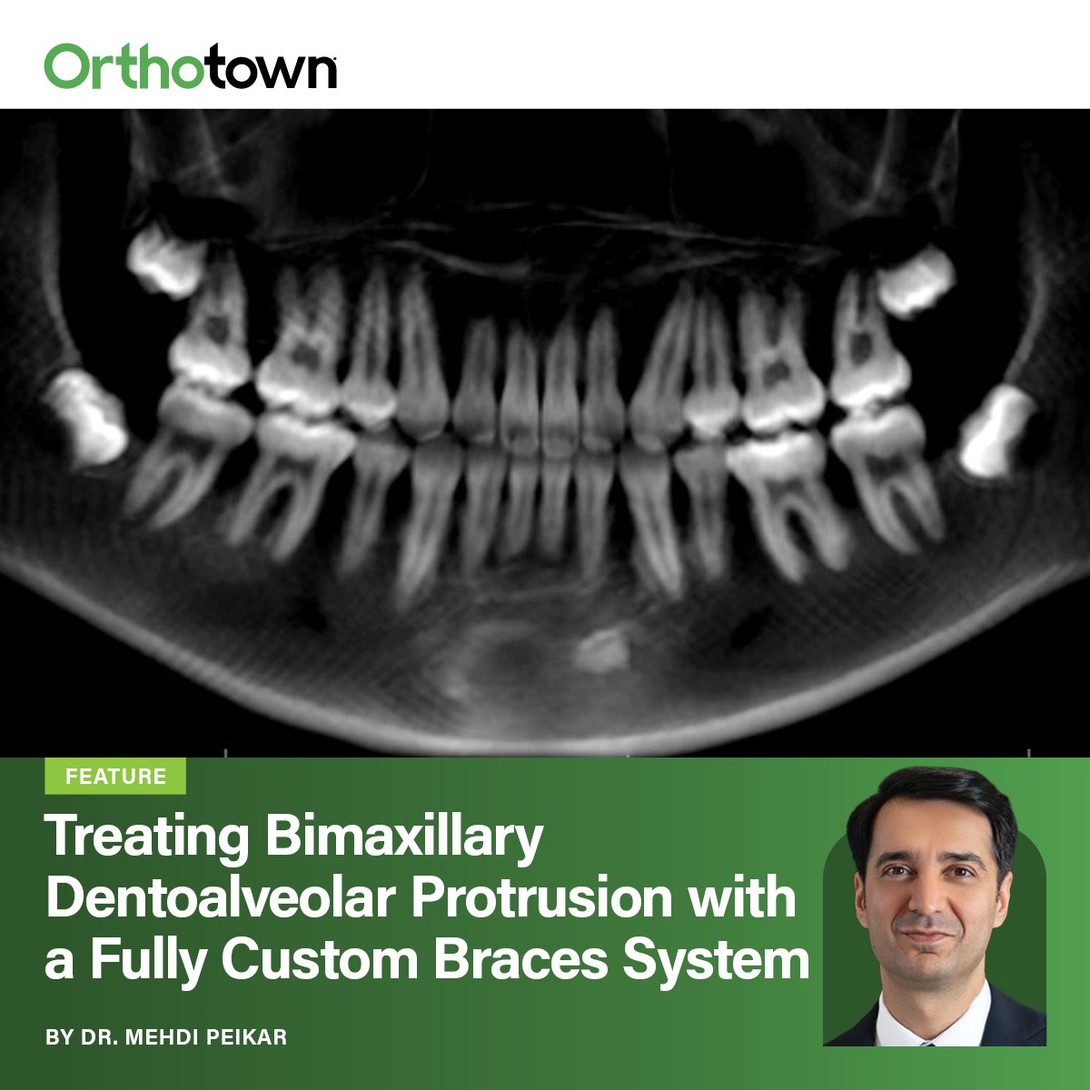 Treating Bimaxillary Dentoalveolar Protrusion with a Fully Custom Braces System Dr. Mehdi Peikar presents a 16-month extraction case using the Celebrace system, demonstrating how custom bracket prescriptions supported precise incisor retraction and improved facial balance.