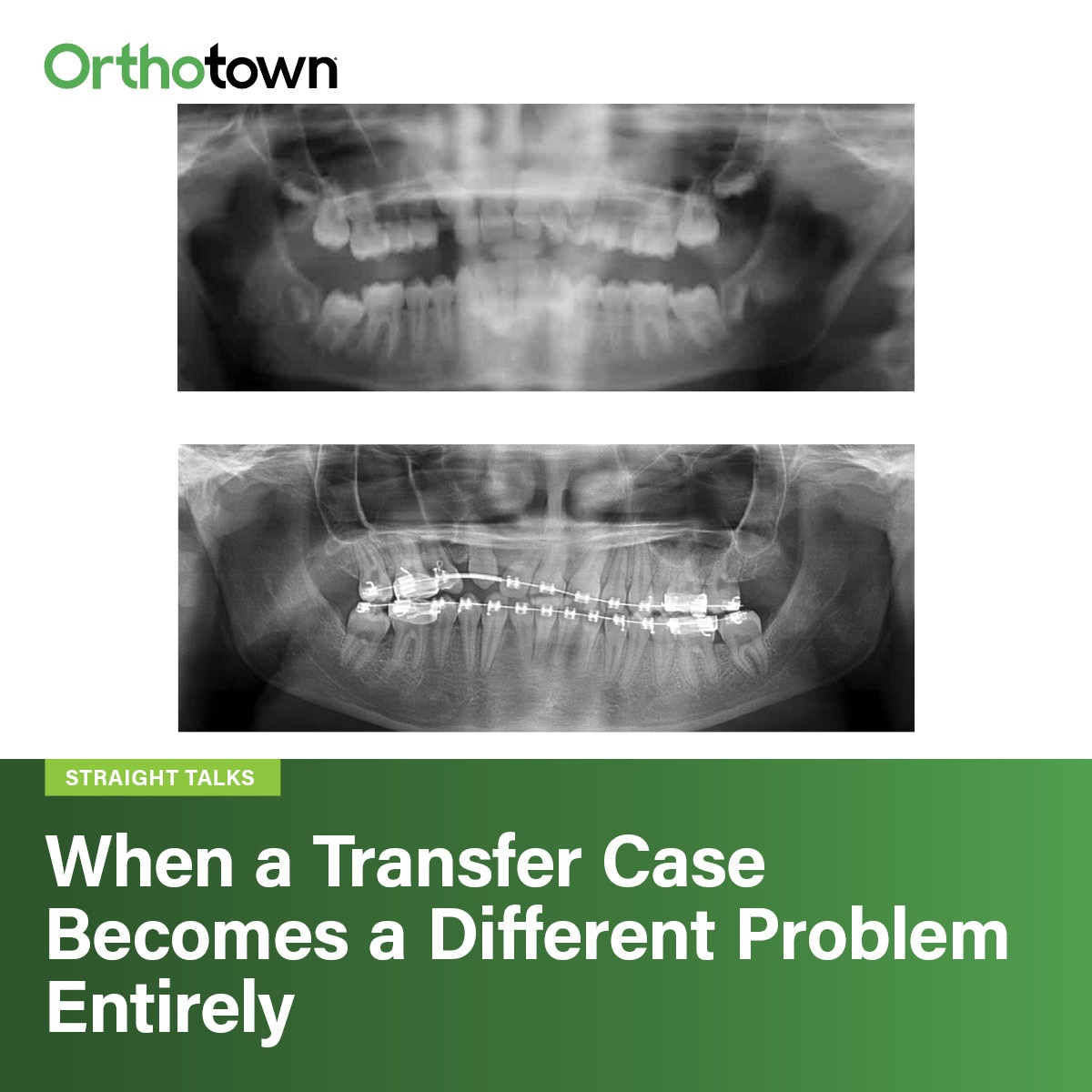 When a Transfer Case Becomes a Different Problem Entirely A complex transfer orthodontic case highlights how early treatment decisions can compound over time, leaving clinicians to choose between attempting canine eruption or planning for a more predictable implant-based outcome.