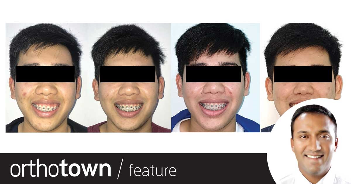 Townie Treatment Case: Can't Be Tamed In the debut installment of this new recurring feature—in which Townies walk readers through the steps of an interesting patient treatment case—Drs. Adith
Venugopal and Anand Marya share a case in which they used TADs to correct a patient’s steep occlusal cant.