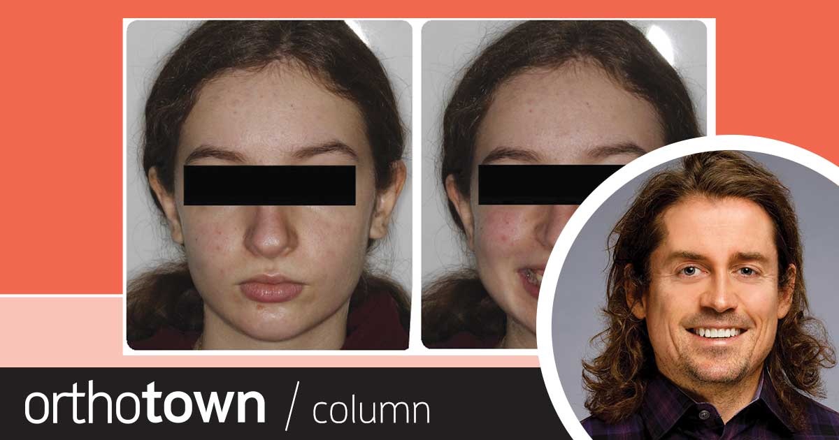 A Voice in the Arena: Lip Trapping Dr. Chad Foster, Orthotown’s editorial director, discusses how lower lip trapping can mask underlying hard-tissue deficiencies, and how to approach such cases.