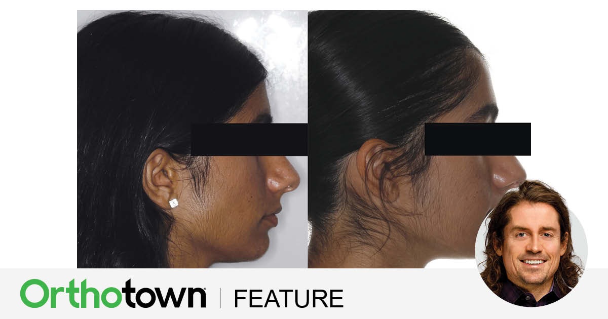 Bite Turbos Meet Outside-In Aesthetics Orthotown editorial director Dr. Chad Foster provides a case presentation with a conscientious approach.