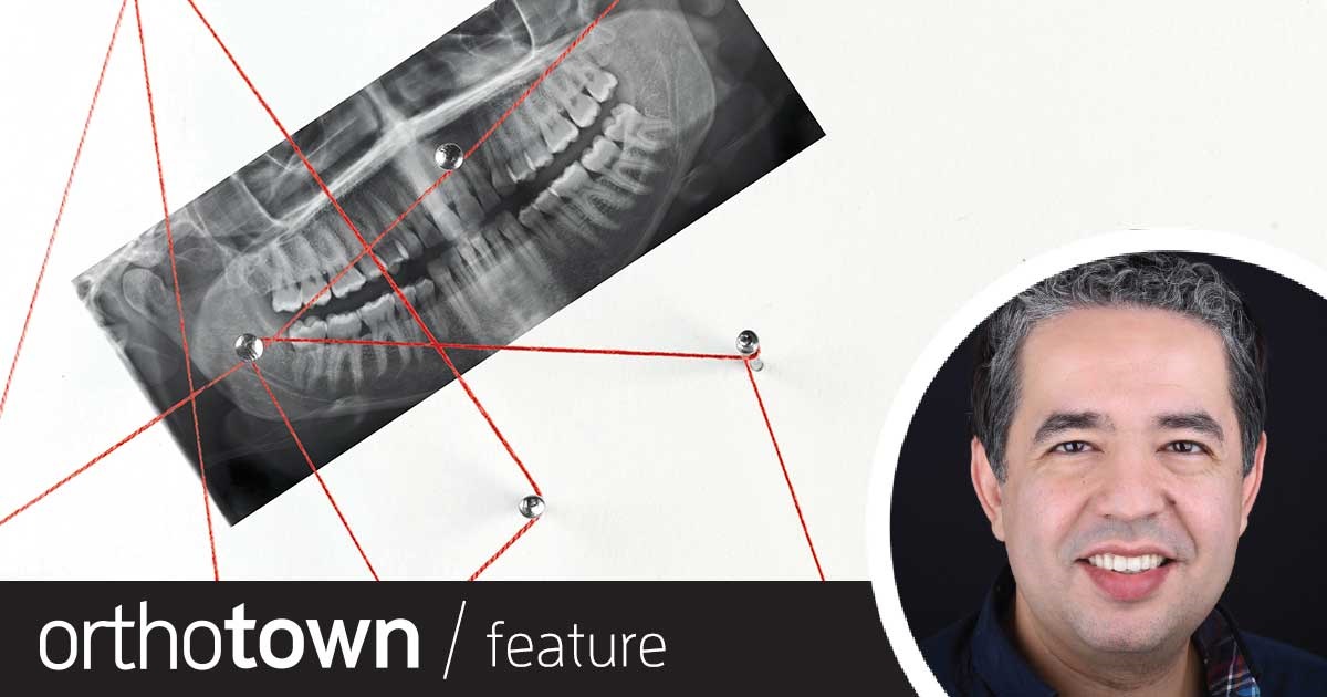 TAD Max Dr. Wassim Bouzid shares a case in which he treated a patient’s gummy smile by using dental TADs and self-ligating braces.