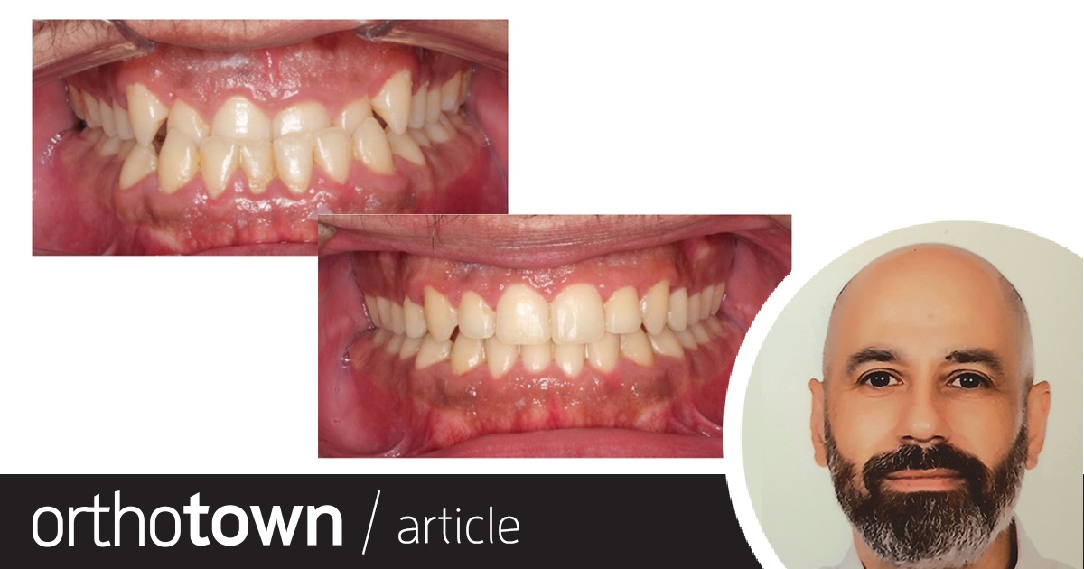 Townie Treatment Case: On the Flip Side Dr. Bilal Koleilat shares a patient case that illustrates how he treated a Class III dentoskeletal malocclusion with self-ligating braces, Class III elastics and buccal shelf TADs.
