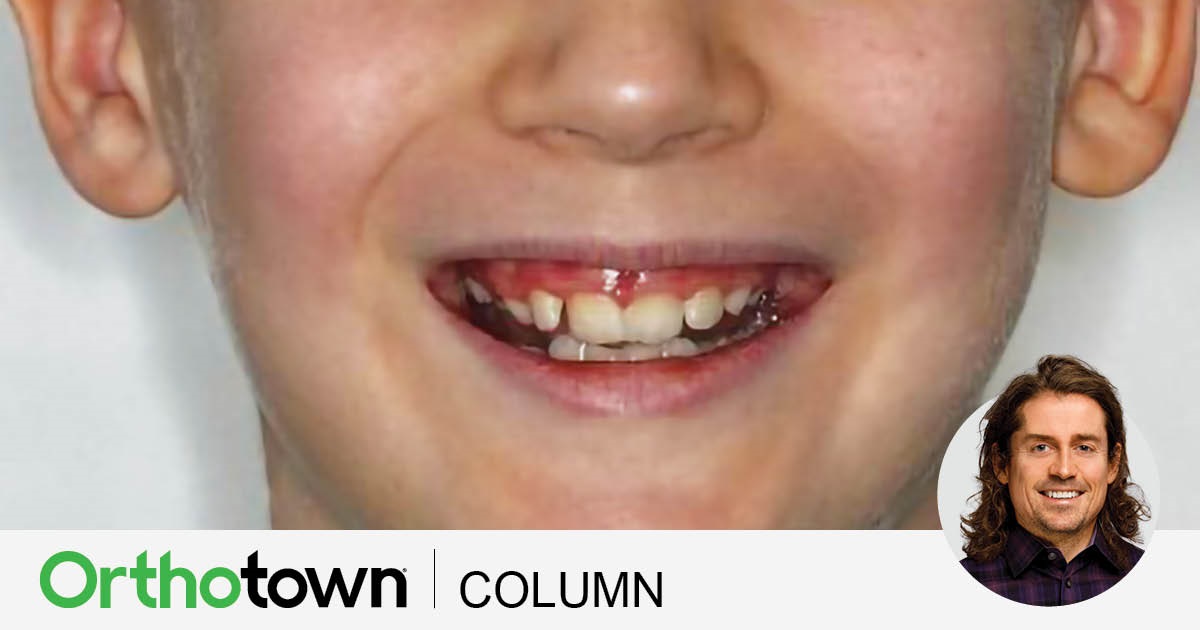 A Voice in the Arena: RPE, Caplin Hooks and Nighttime Elastics Dr. Chad Foster, Orthotown’s editorial director, discusses the use of Caplin hooks and nighttime elastics to assist rapid palatal expansion in some patients.