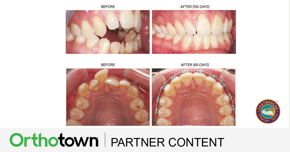 Product Profile: Fastbraces A patented method of alveolar bone restoration