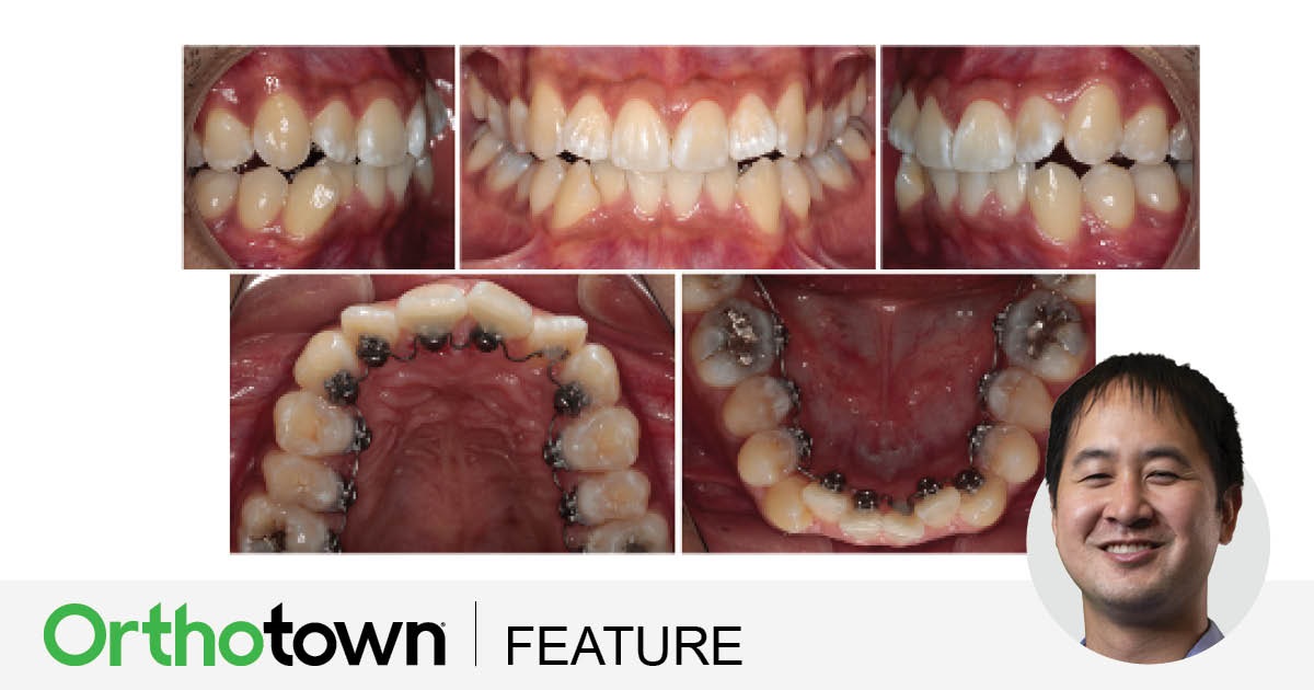 Townie Treatment Case: Sight Unseen Dr. Robert Lee shares a case study in which an adult patient opted for treatment with lingual braces, but his lingual archform initially didn’t have enough space to bond all the brackets required for treatment. 