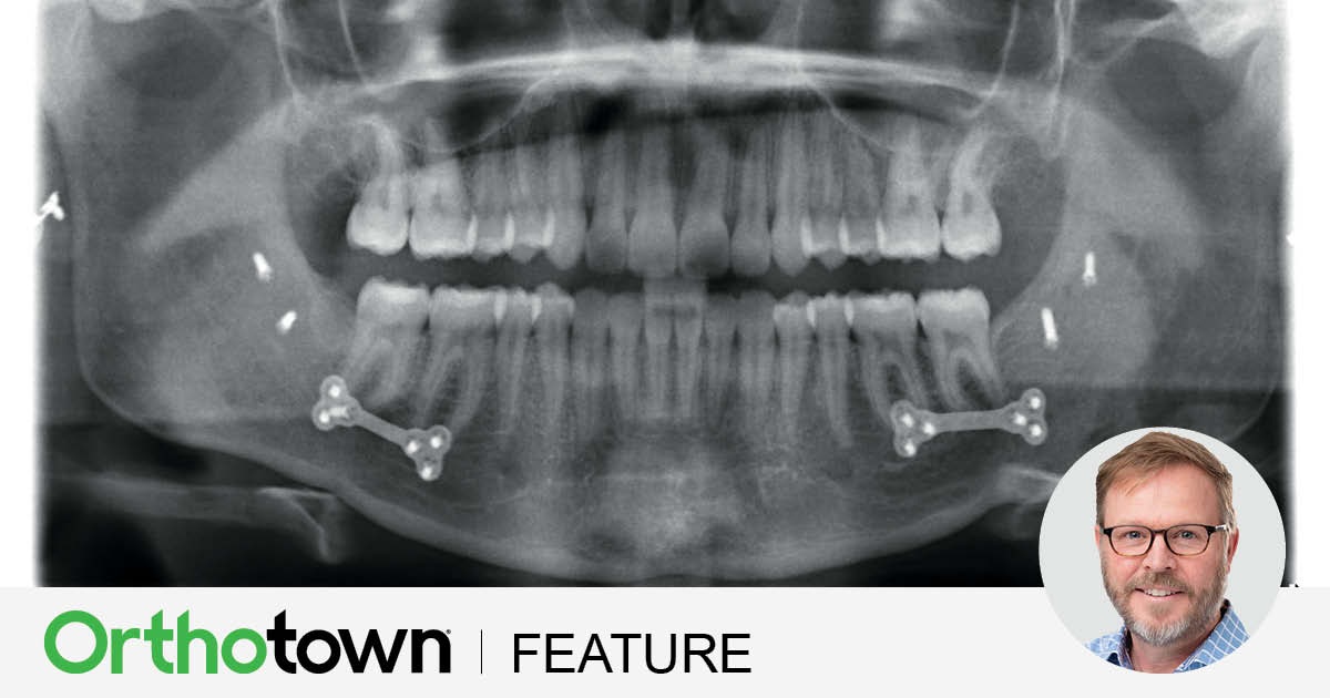 Surgical Orthodontic Treatment with Aligners Dr. Mark L. McInnis shares a complex surgical case treated with aligners that highlights planning strategies, TAD use and how surgery resolved a posterior arch discrepancy.