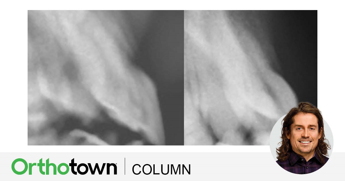 A Voice in the Area: Maxillary Central Incisor Labial Surface Shape Editorial director Dr. Chad Foster shares a case study that illustrates the importance of the aesthetics of the maxillary anterior teeth.