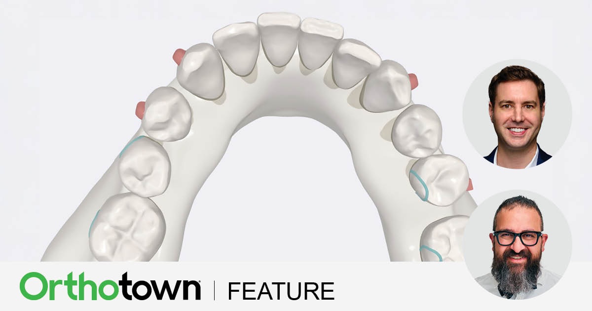 Tooth vs. Tray Drs. Chris Cetta and Rooz Khosravi share biomechanics and outcomes of elastic buttons bonded to teeth versus those integrated into aligners.