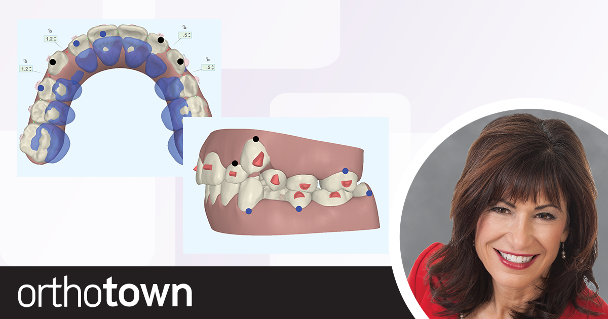 Clear Aligners in Phase 1 Treatment Orthotown editorial board member Dr. Donna Galante shares a case study and discusses Invisalign First, clear aligners for Phase 1 patients who need space creation in early to middle mixed dentition.