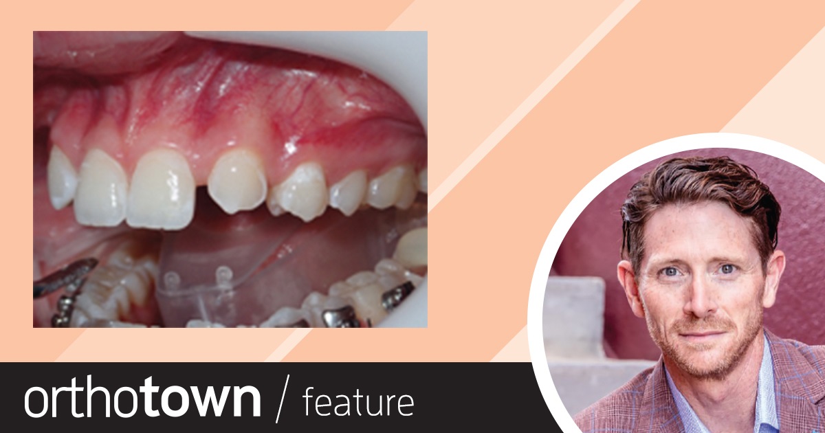 Cuspid Substitutions Dr. Robert “Tito” Norris shares techniques for predictable excellence when using a cuspid to replace a missing maxillary lateral incisor. His step-by-step guide is accompanied by a case study, and key considerations to optimize the aesthetics and function of this treatment option.