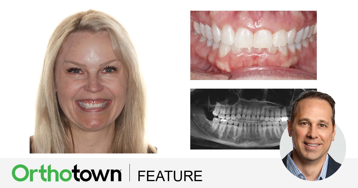Townie Treatment Case: TADs, Clear Aligners and Overkill Dr. Bill Dischinger presents an early case in which he used TADs and clear aligners to treat a patient who had an open bite and a gummy smile—and inadvertently burned out the patient in his attempt to achieve an absolutely perfect smile.