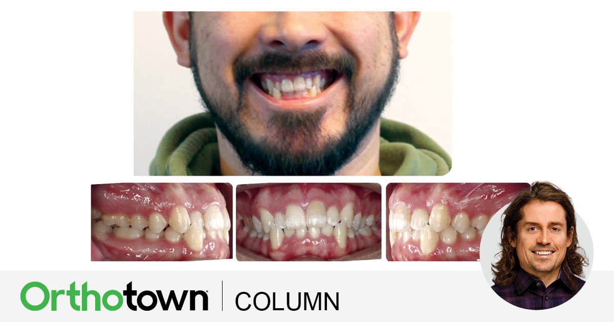 A Voice in the Arena: Early Cant Protocol: Asymmetric Bite Turbos and Elastics Editorial director Dr. Chad Foster shares a bite turbo and elastic pairing that he’s found works well for mild anterior cants.