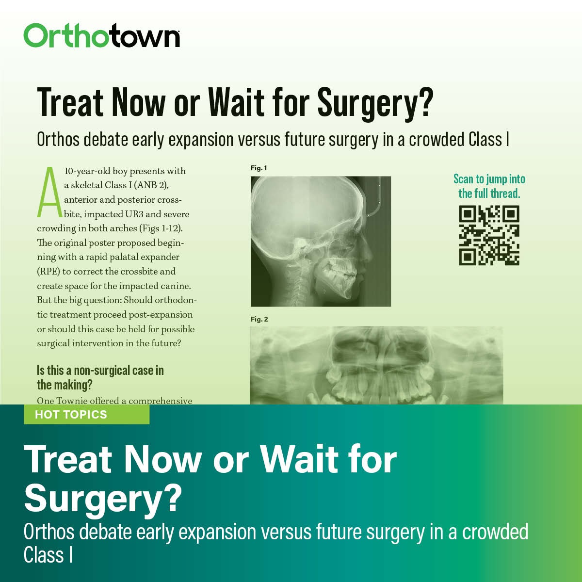 Treat Now or Wait for Surgery? Orthos debate early expansion versus future surgery in a crowded Class I