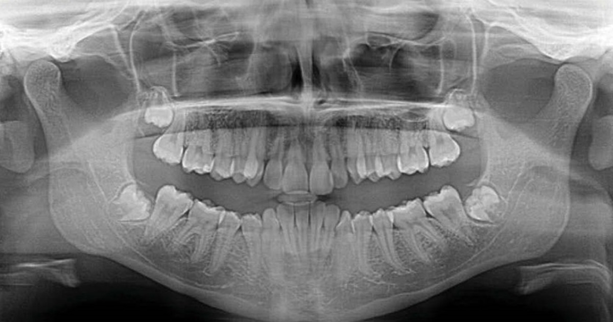 Earned Placement: Damon Ultima System Leveraging innovative technologies and phase-based protocols in a Class 2 case can restore the most valuable asset we have: time!