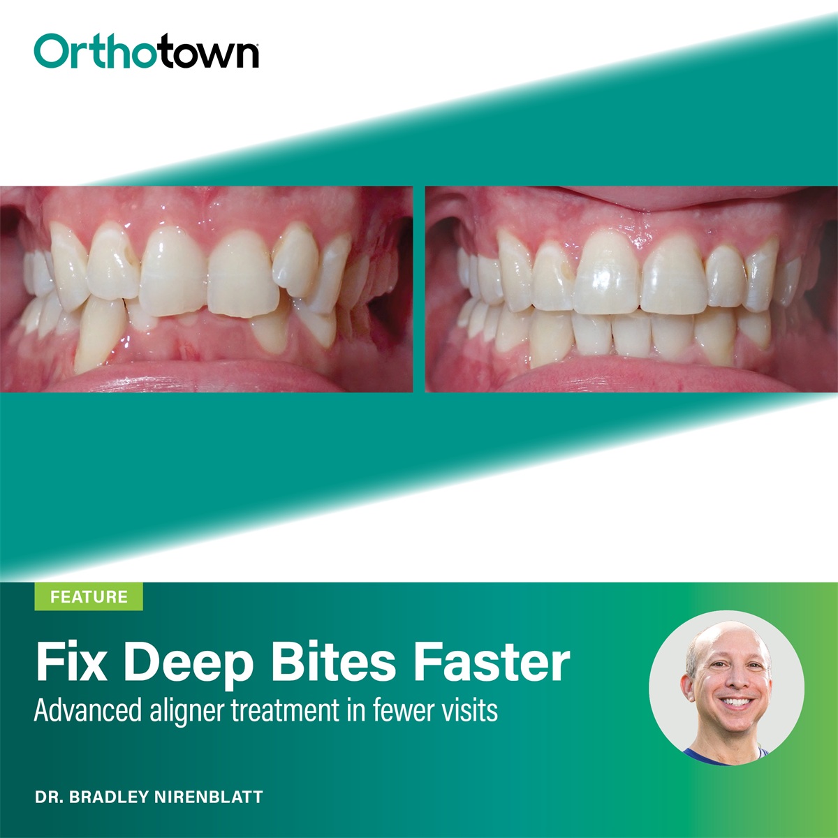 Fix Deep Bites Faster Dr. Bradley Nirenblatt highlights a young servicemember’s case completed in seven and a half months with aligners and remote monitoring.