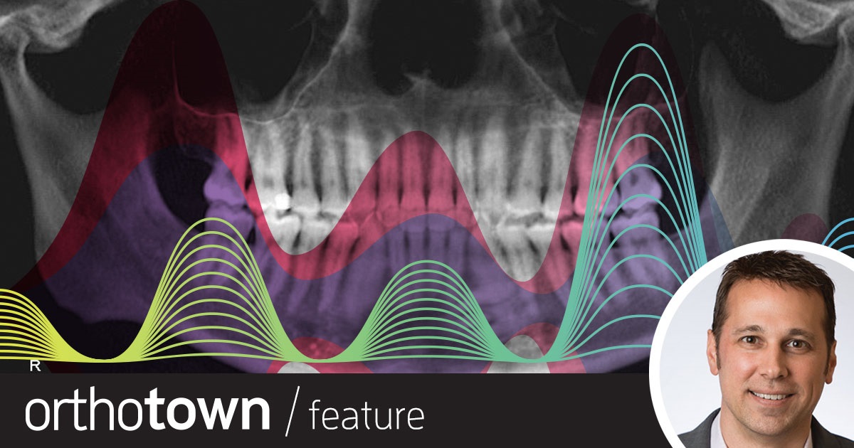 Buzzing Through Treatment Dr. Bill Dischinger shares a case study in which high-frequency vibration helped speed passive self-ligation treatment and upright canines to prepare for gingival grafts.