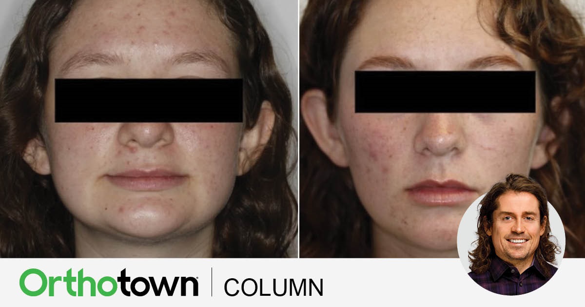 A Voice in the Arena: 'Short-Face' Patients Editorial director Dr. Chad Foster begins a four-part series about treatment considerations for patients whose faces have short lower thirds.