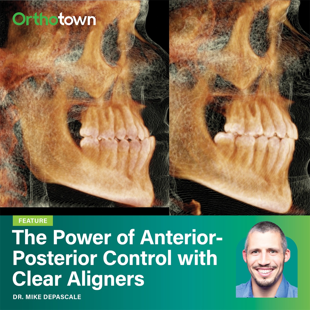 The Power of Anterior-Posterior Control with Clear Aligners Dr. Mike DePascale shows how clear aligners can deliver effective anterior-posterior control while simplifying treatment without extractions or complex appliances.