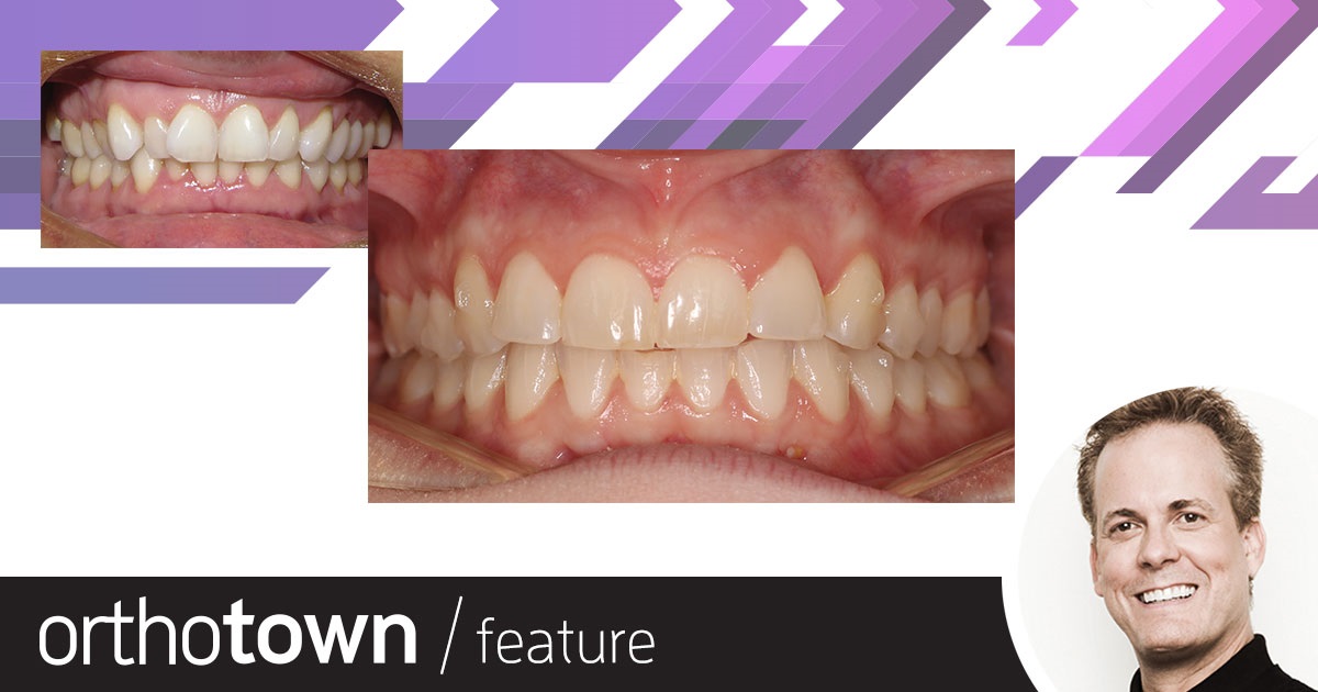 Getting Things Back on Track Dr. R. Bruce McFarlane shares cases in which he used manual osteoperforation and high-frequency vibration to help speed treatment of deep bite using clear aligners.