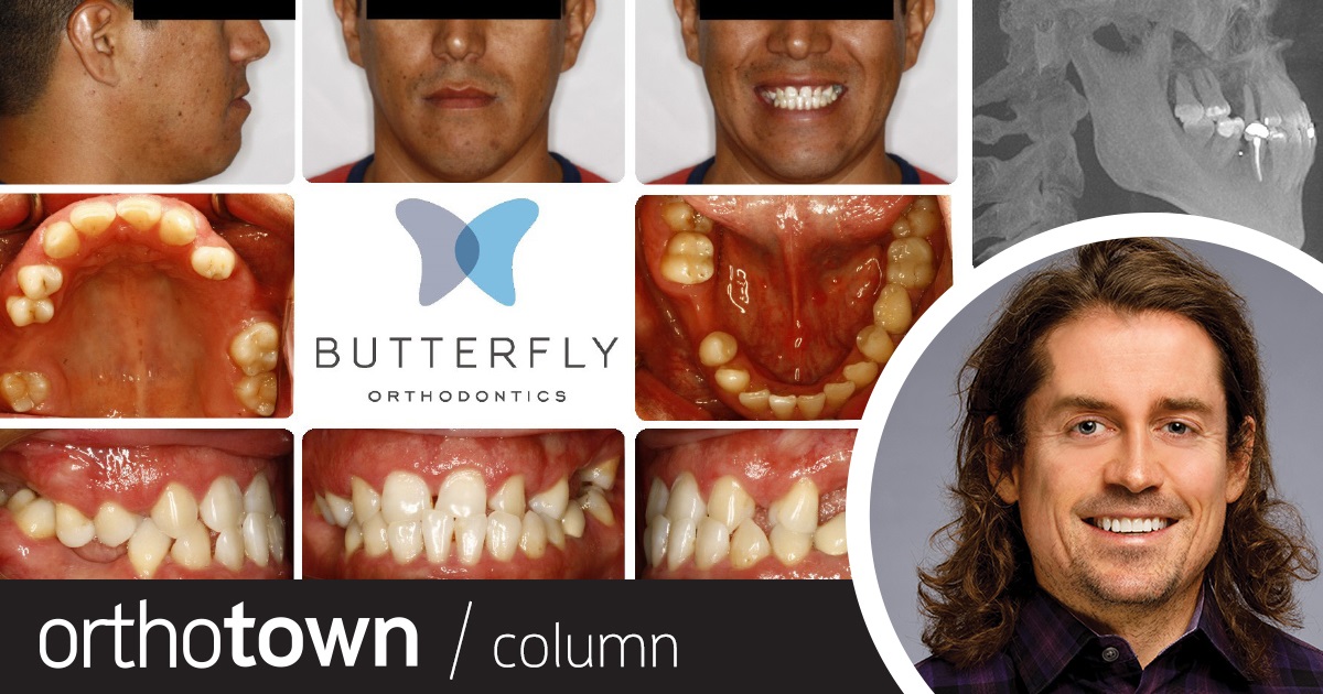 A Voice in the Arena: Adult Orthodontic Rehab Cases Orthotown Editorial Director Dr. Chad Foster discusses the lessons he’s learned when treating adult orthodontic rehabilitation cases, and the four items he needs to be
comfortable with before he agrees to take on a new patient who needs such care.
