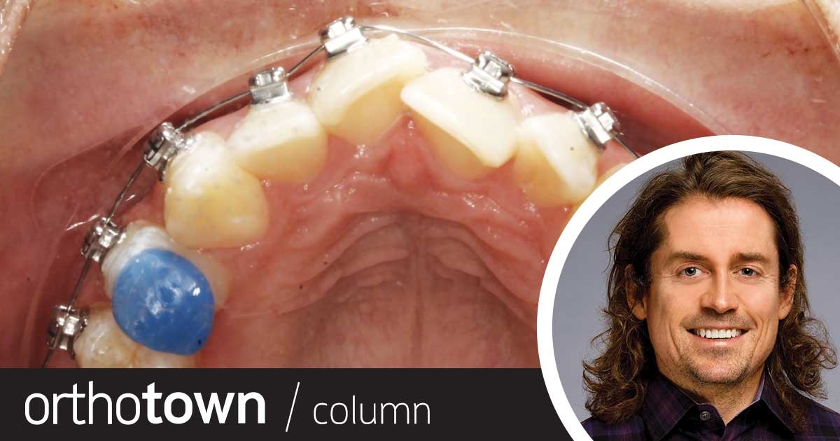 A Voice in the Arena: Bite Ramps, Part 1: Class 2 Bite Ramps Orthotown Editorial Director Dr. Chad Foster discusses how strategically positioning and shaping bite turbos has been a huge game-changer in clinical efficiency at his practice.