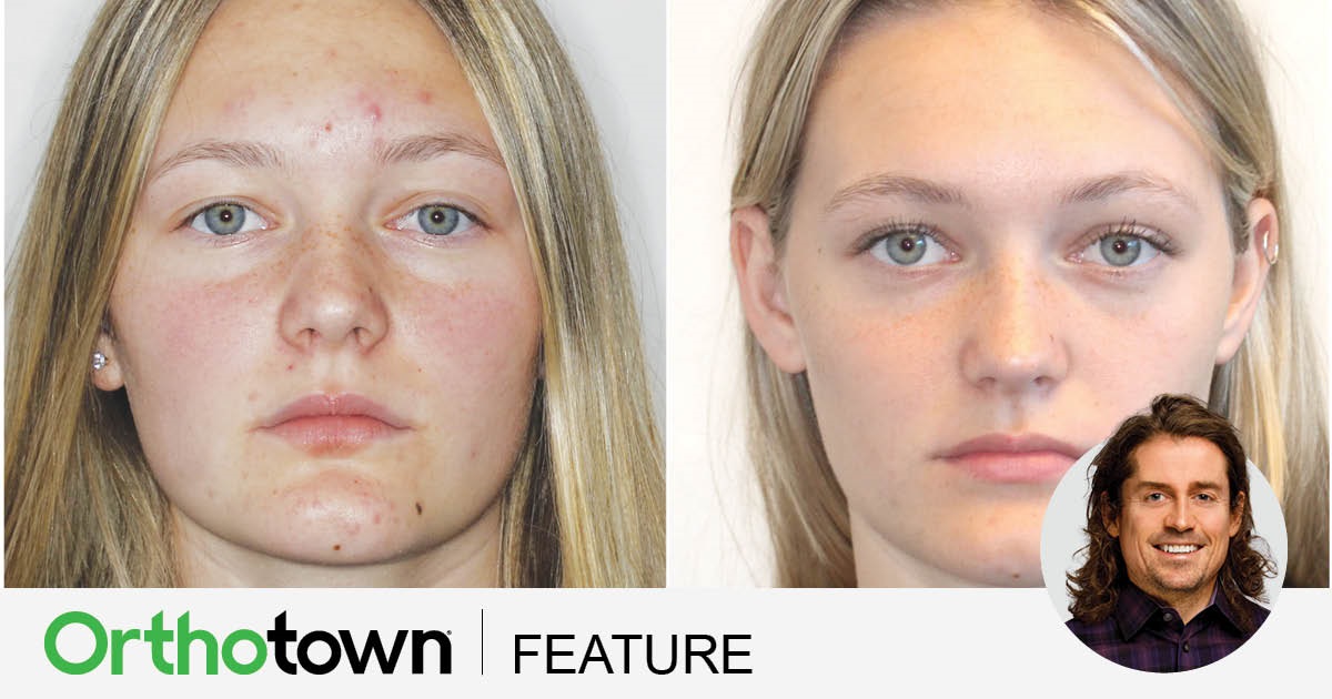 ‘Short-Face’ Patients—Part 2 In this second installment on treating “short-faced” patients, Dr. Chad Foster presents a case study highlighting aesthetic improvements achieved through bite turbos and elastic strategies to increase lower facial height. 