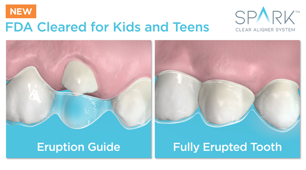 Spark Clear Aligners Receive New FDA Approval