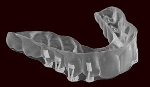 Solventum Launches First 3D Printed Aligner Attachments
