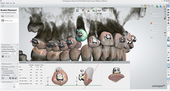 3Shape Orthodontic Software Integrates with Ormco Damon System Brackets