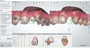 3Shape Orthodontic Indirect Bonding Solution Integrates with RMO Bracket Systems