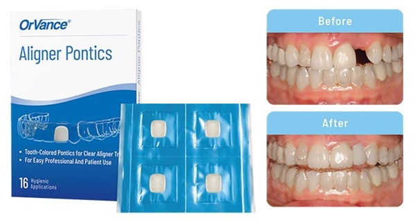 OrVance Launches the First Aligner Pontics Solution for Patient Use