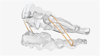 Ormco Launches Spark Retainers and Spark Bitesync 